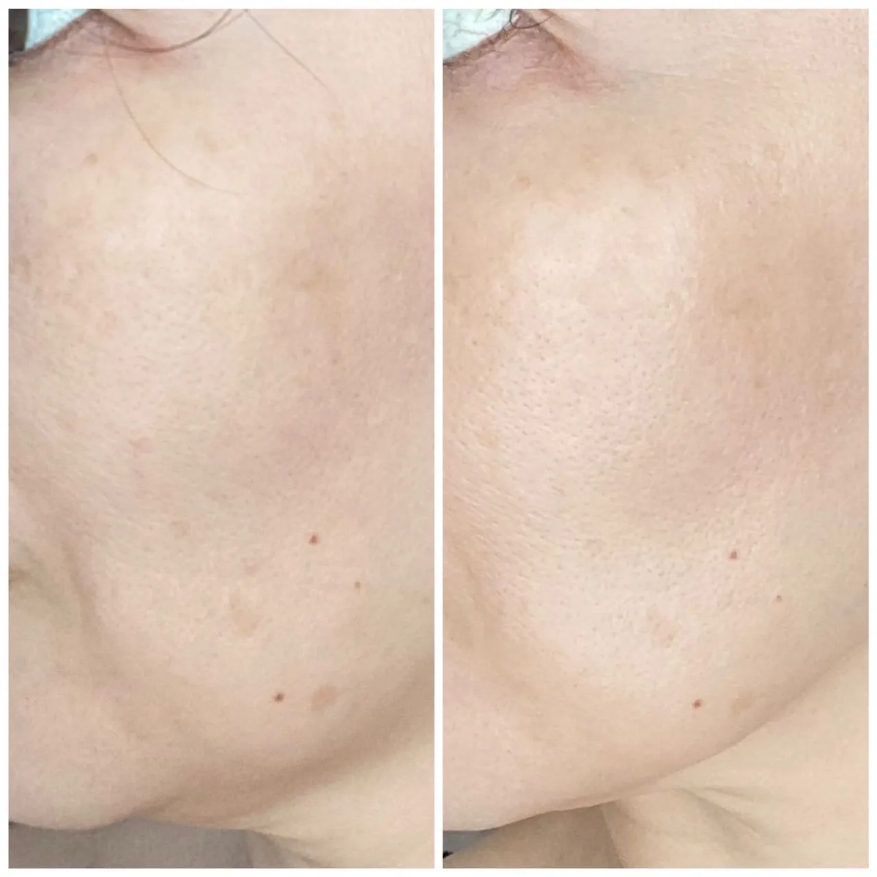 初夏のフェイシャルケア