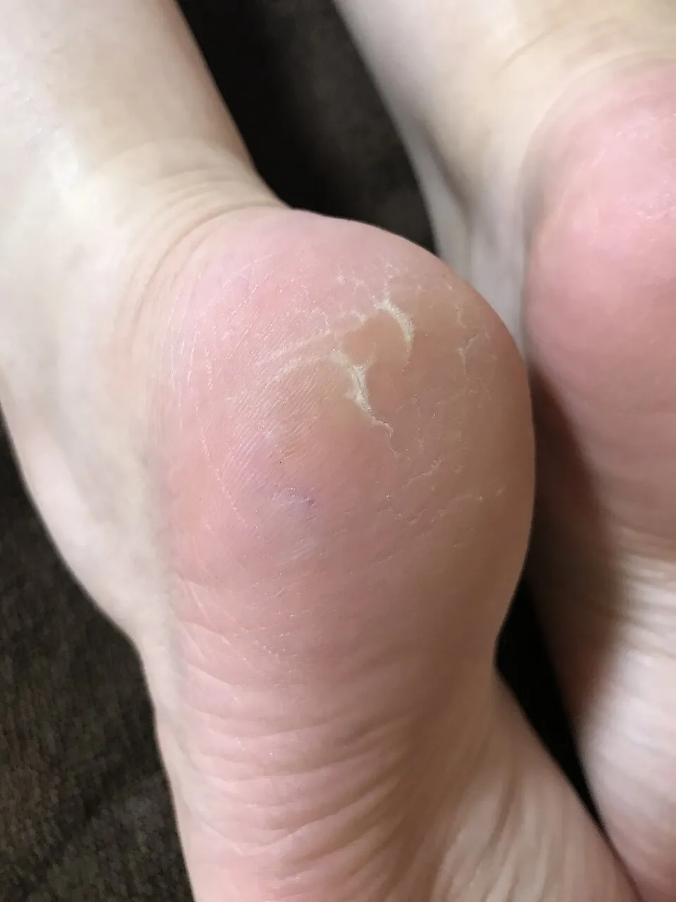 サンダルの季節が来る前に!今から始める「足裏のごわつき・かかとケア」